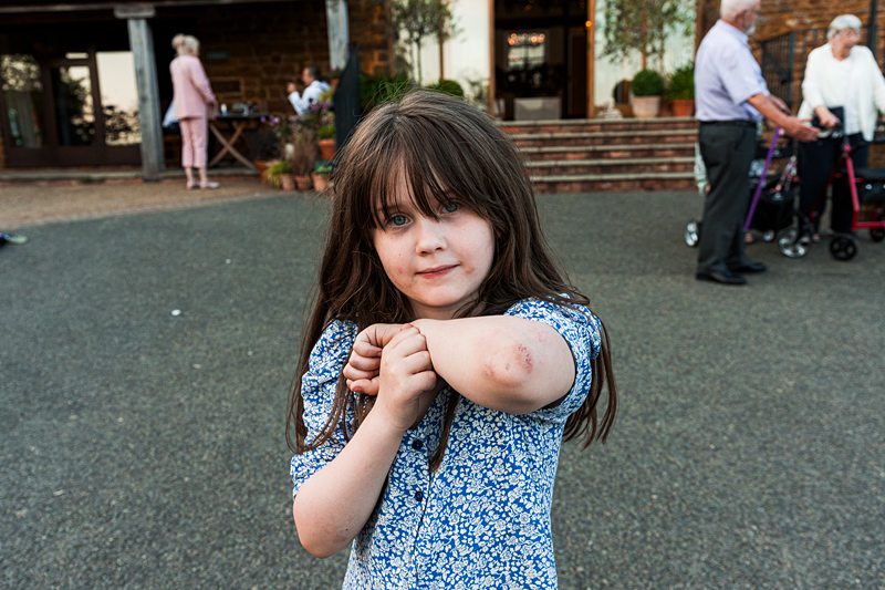 Girl showing bruised elbow outside house